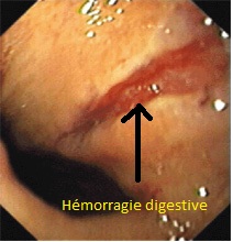 Hémorragie digestive